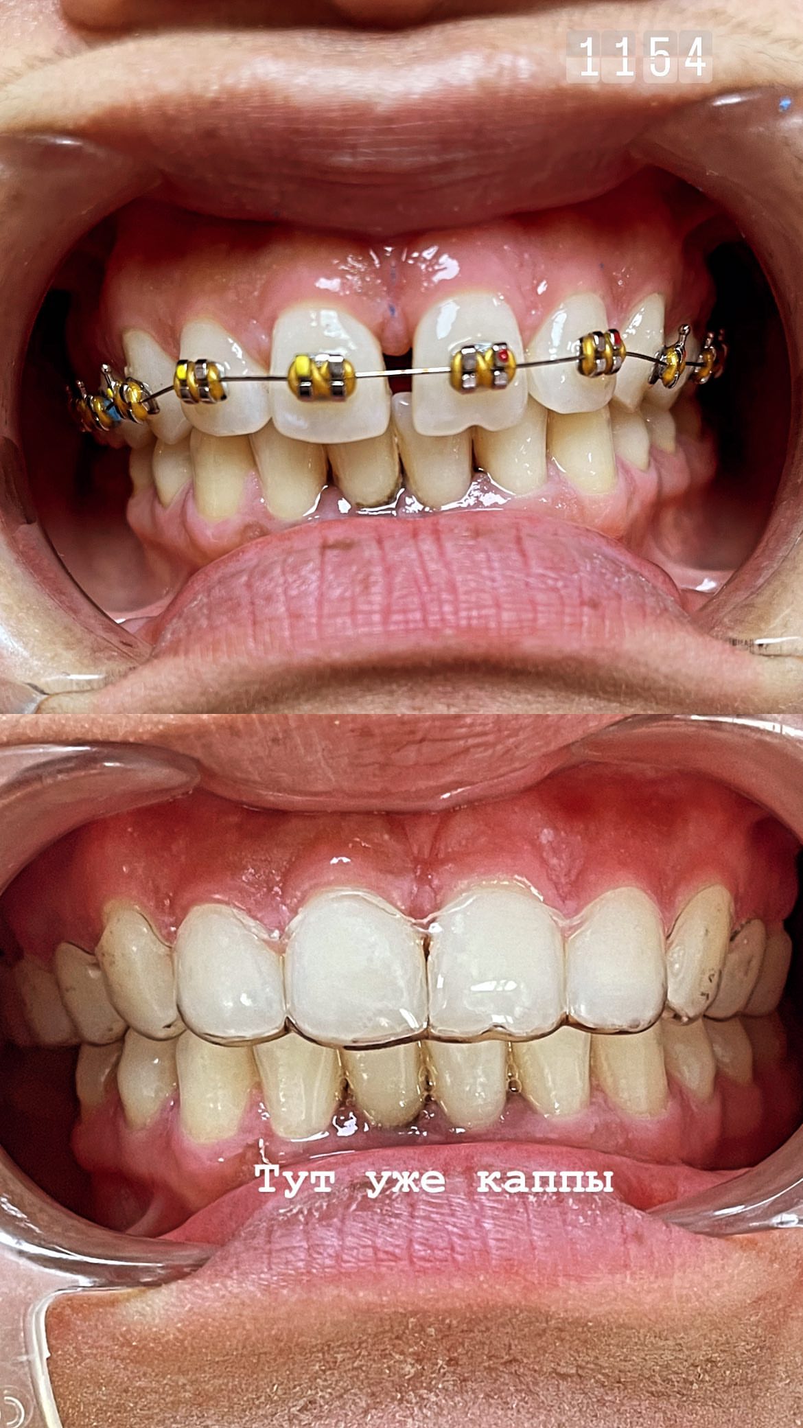 Циркониевые коронки