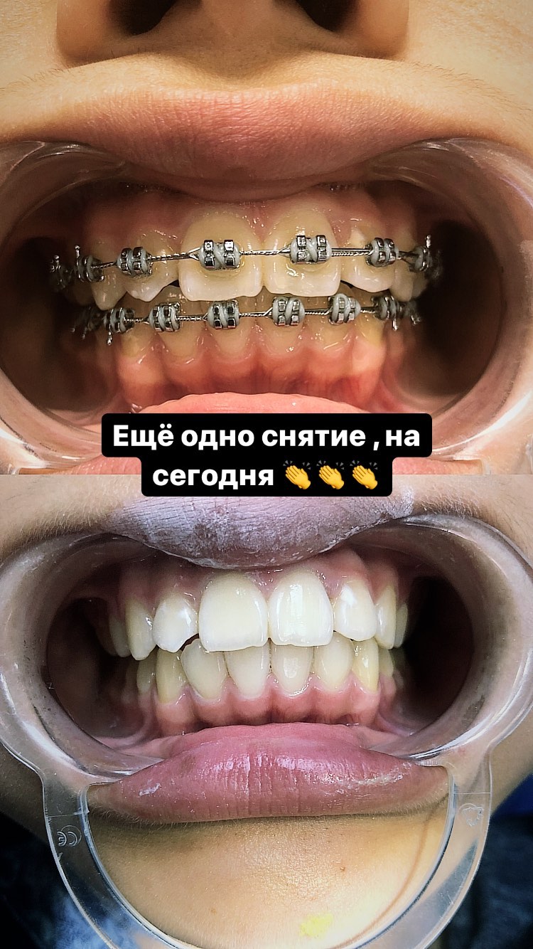 Коронки ПММА