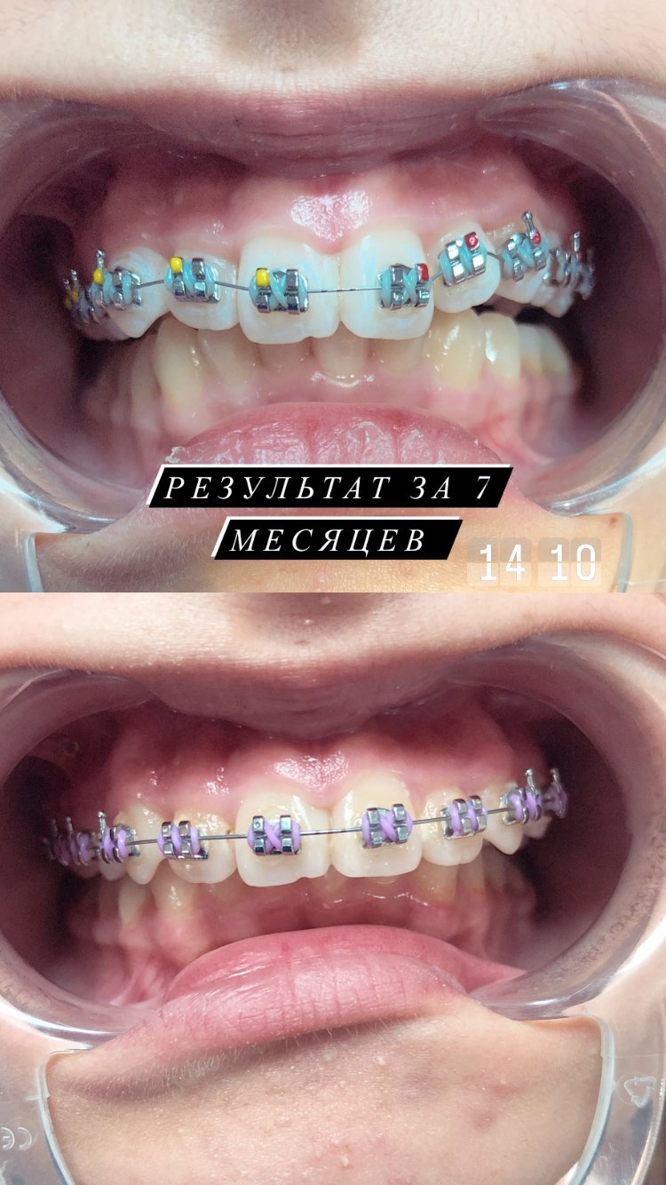 Протезирование