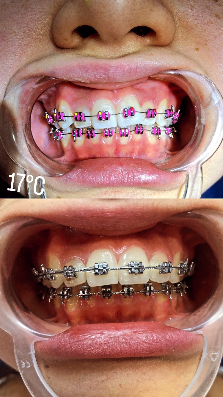 Отбеливание зубов