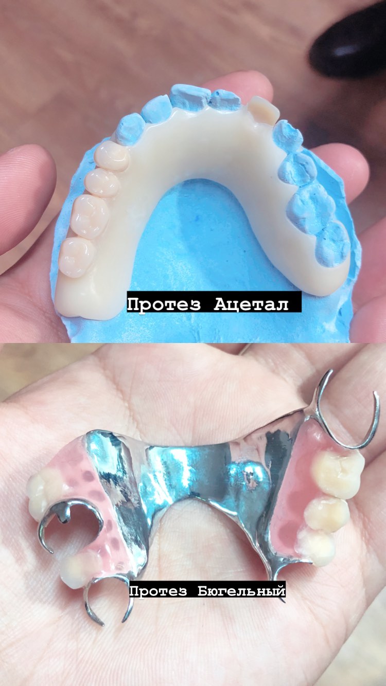 Протезирование