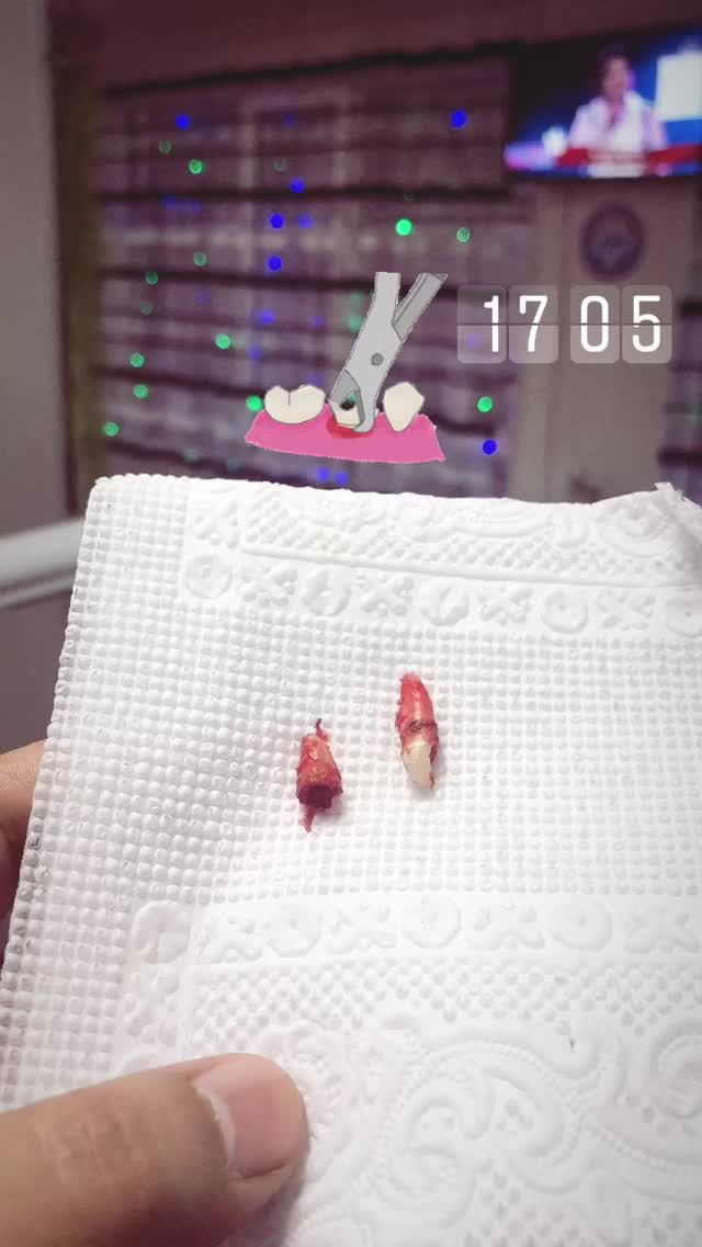 Удаление зуба