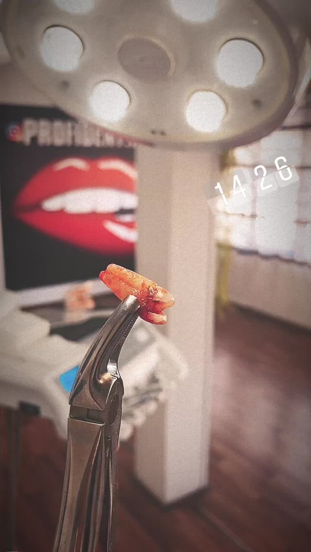 Удаление зуба