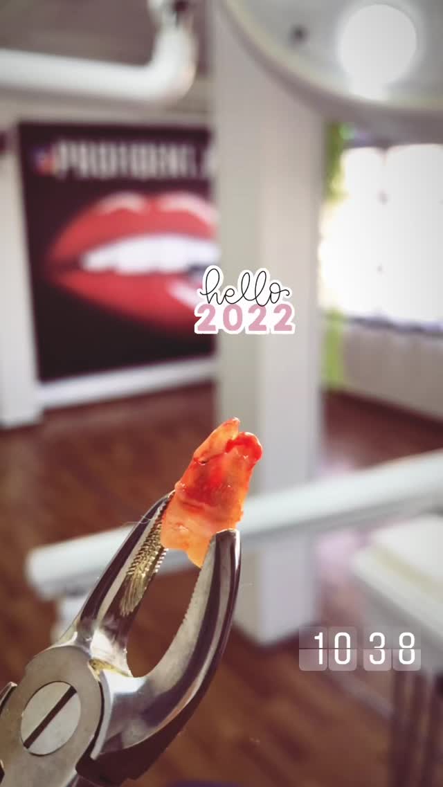 Удаление зуба мудрости