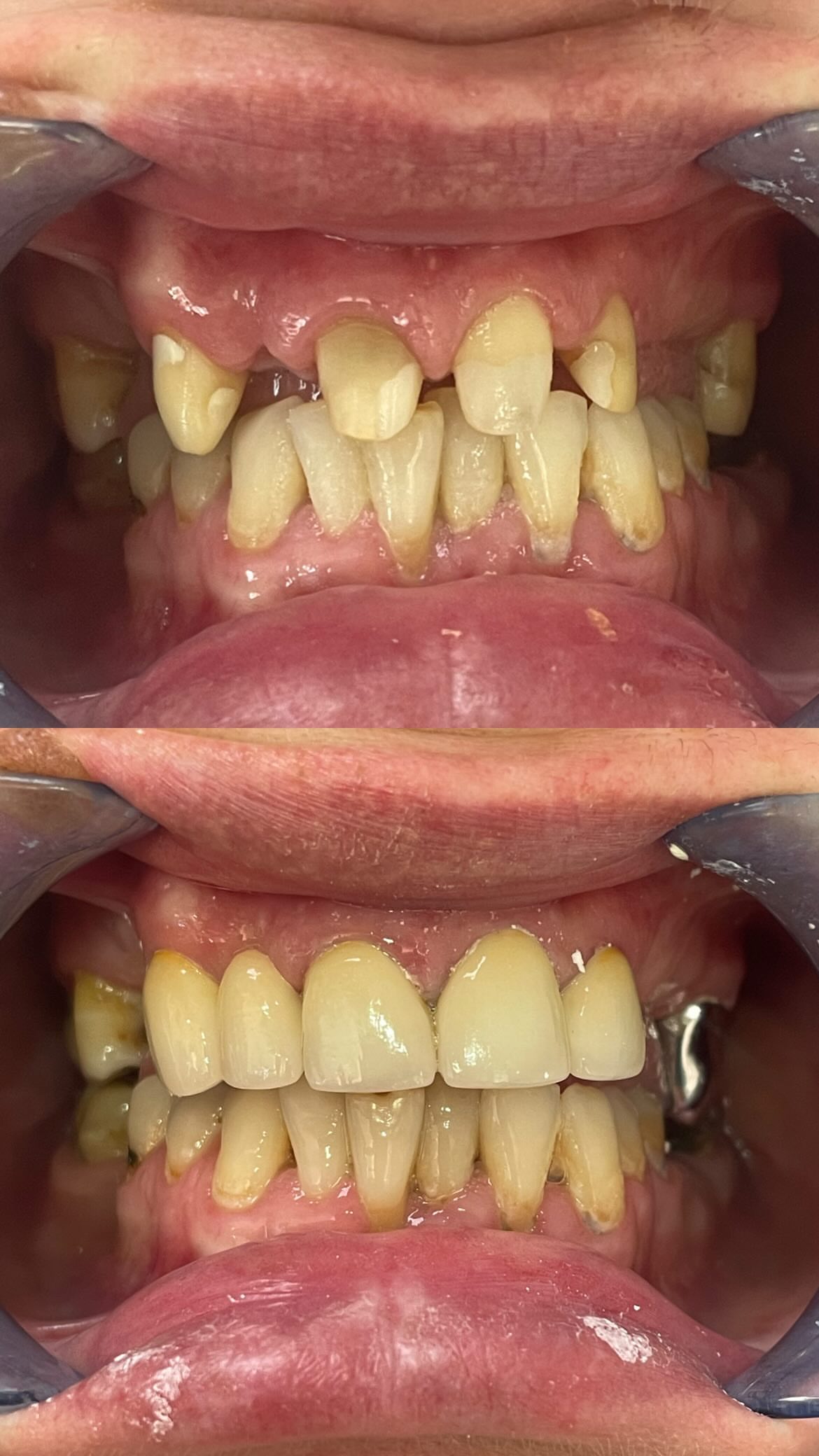 Металлокерамика