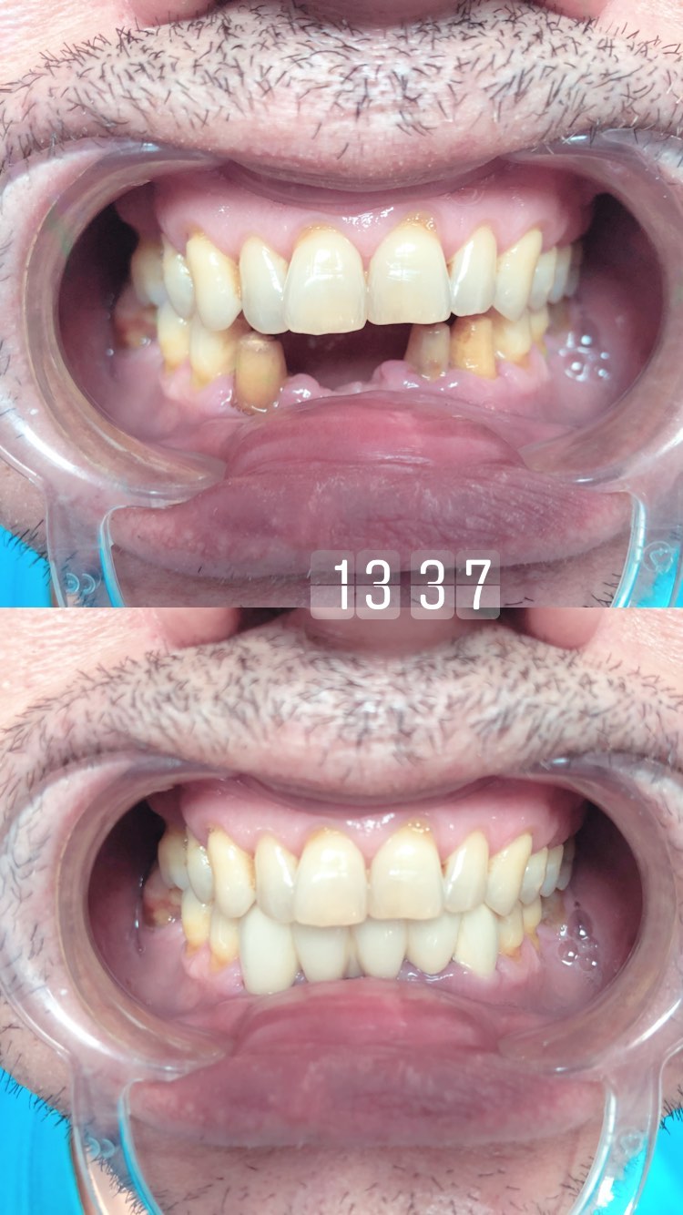Металлокерамика — результат