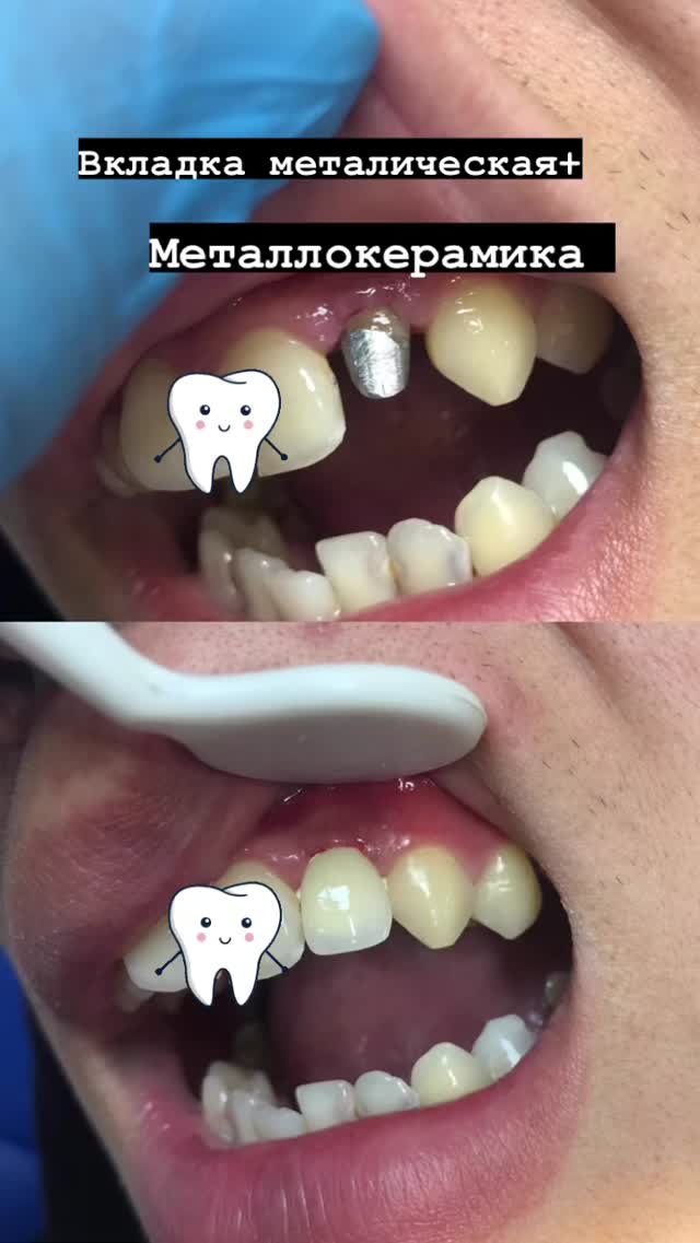 Металлокерамика — результат