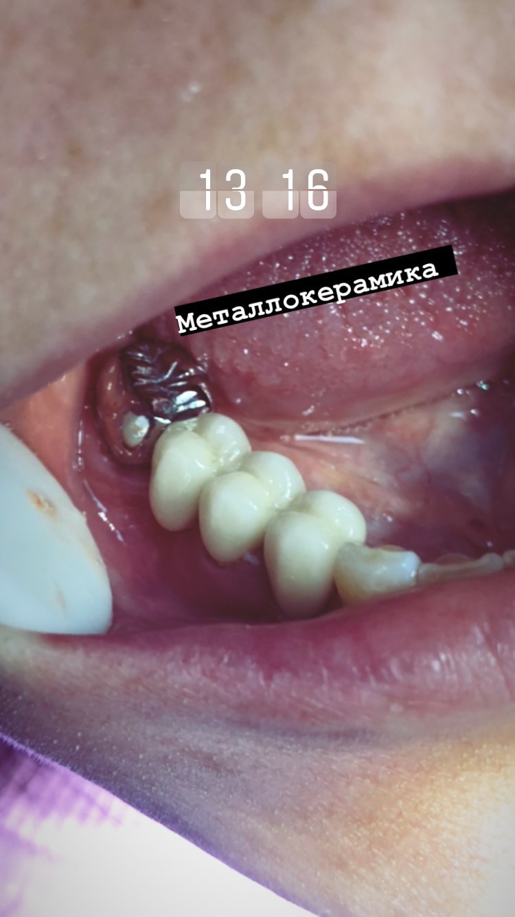 Металлокерамика