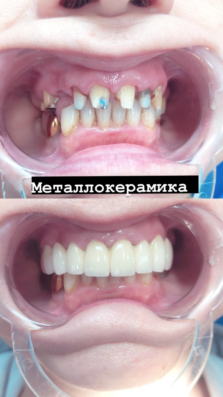 Металлокерамика