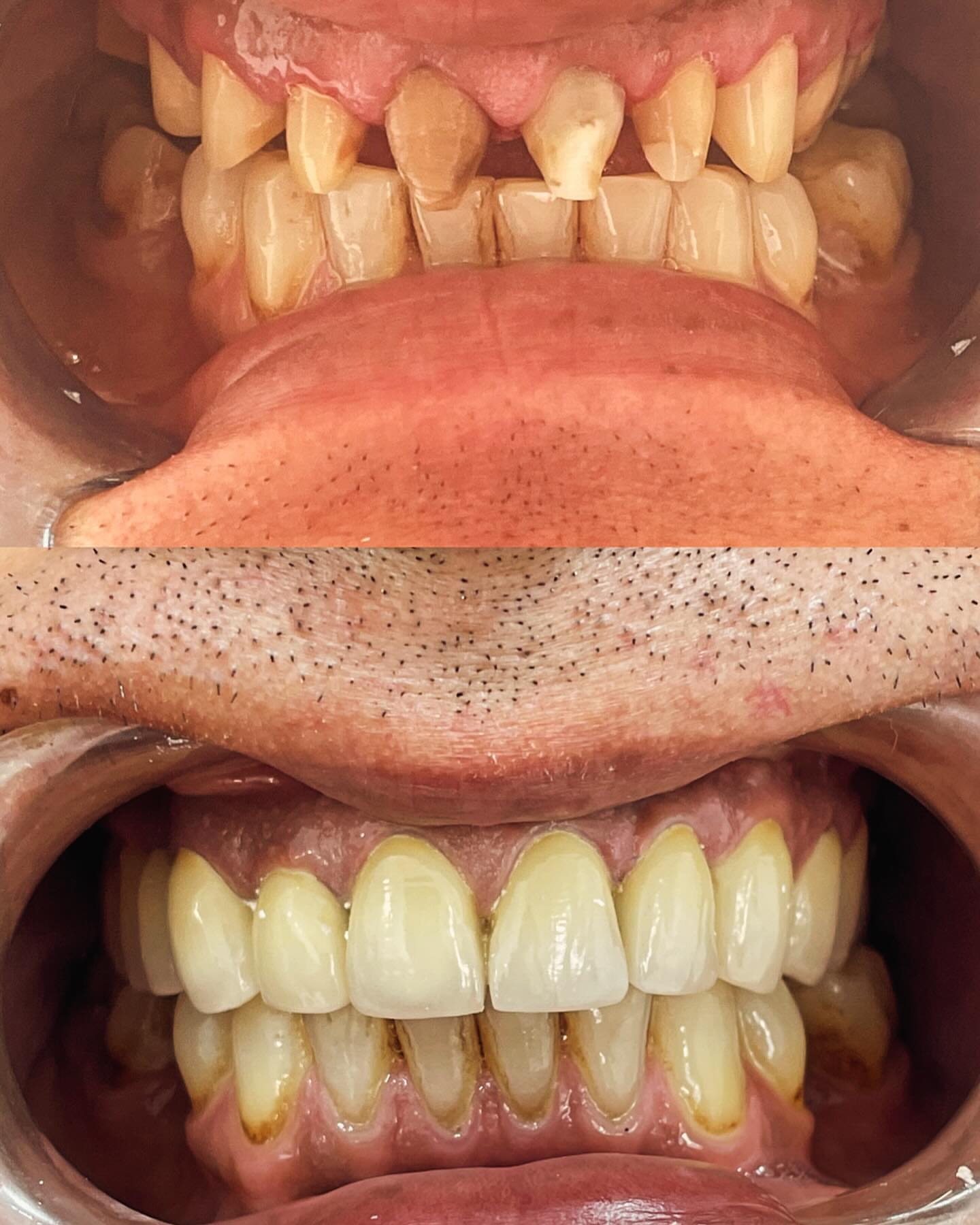 Металлокерамика