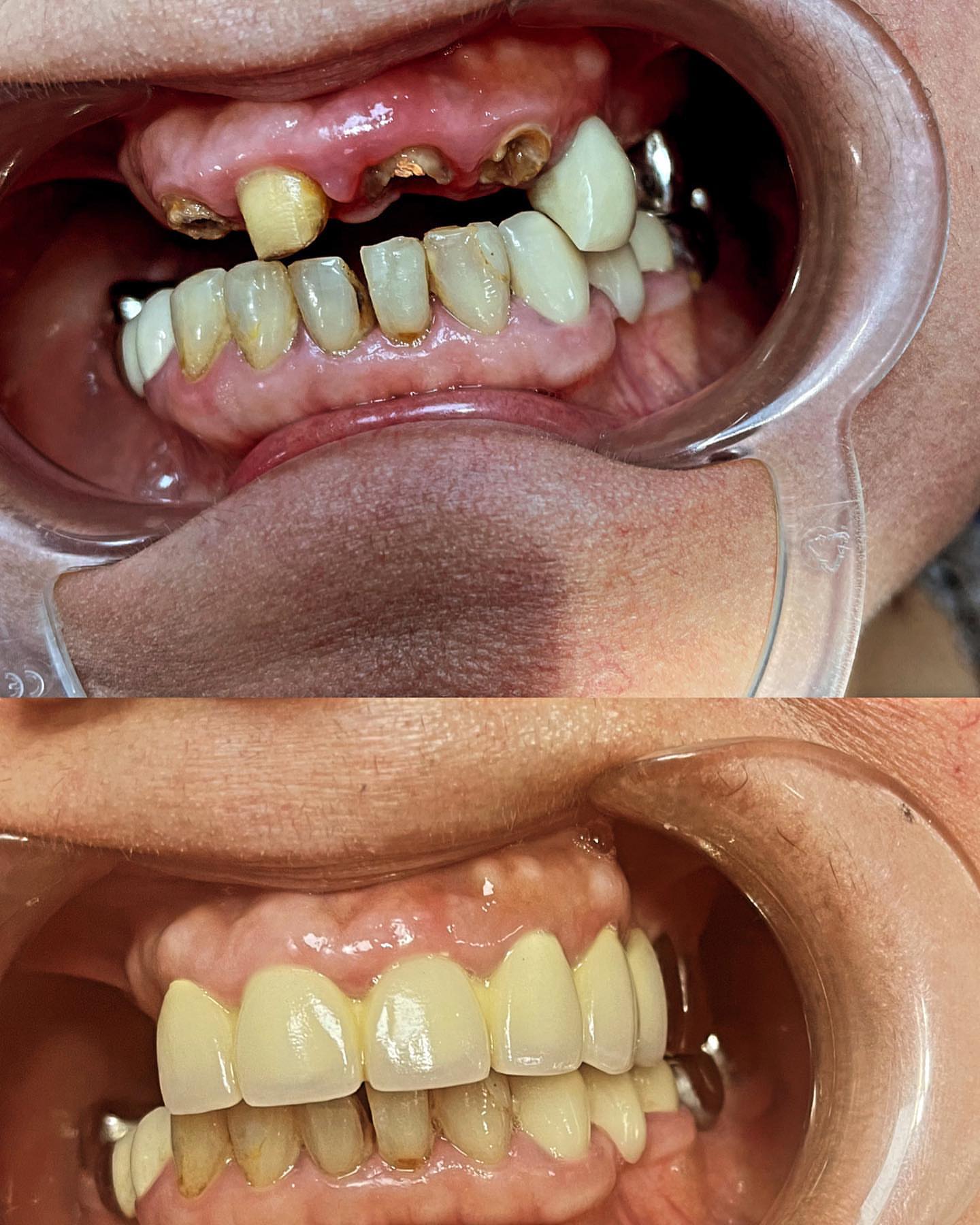 Вкладка металлическая