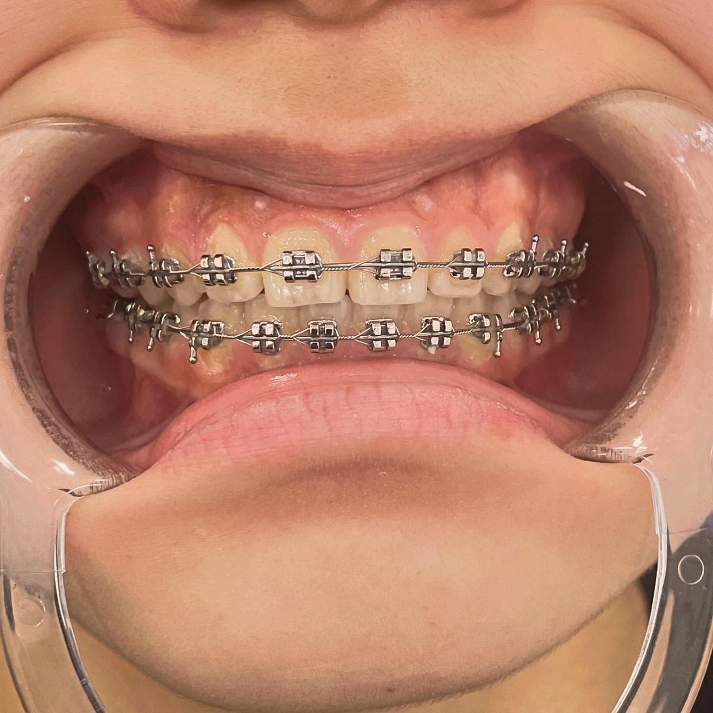 Брекет-системы